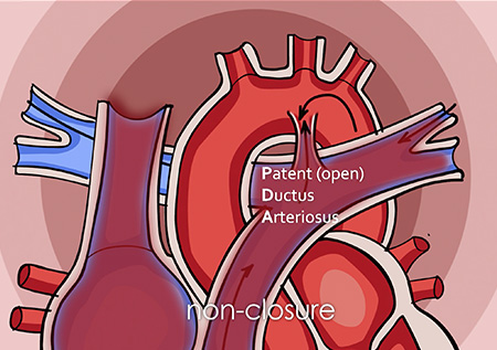 Patent Ductus Arteriosus (PDA) closure video preview
