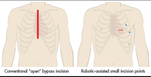 diagram of incisions in bypass procedures