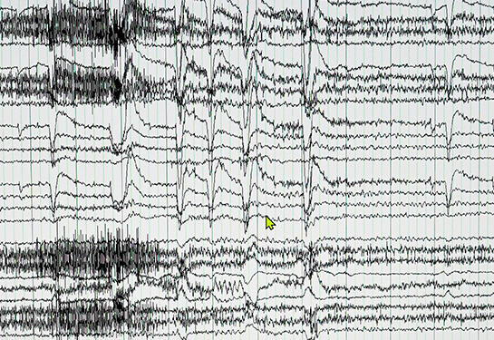 A computer screen shows a white background with EEG waveform readouts and continuous video of a patient.