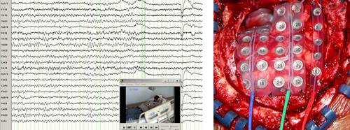 eeg tracings and leads placement