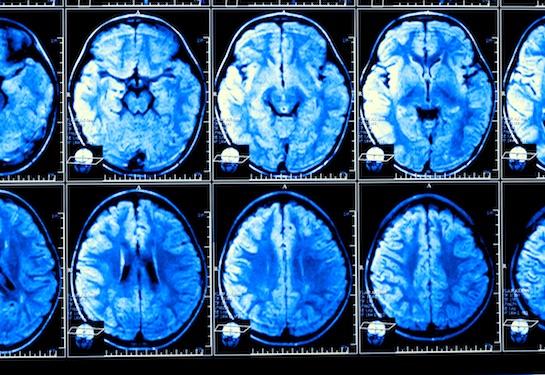 Multiple images of an MRI (magnetic resonance imaging) of a human head.