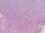 Figure 1: Low power (4X) view of tumor (top) and uninvolved hepatic parenchyma (bottom), note the infiltrative border.