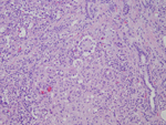 Figure 3:  High-power (20X) view of tumor with intravascular polypoid projection of epithelioid cells.