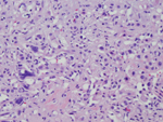 Figure 2: High-power (40X) view of epithelioid cells. Note presence of multinucleated cells and cells with intracytoplasmic lumens.