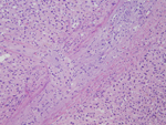 Figure 5: High power (20X) view of tumor filling a large vein.