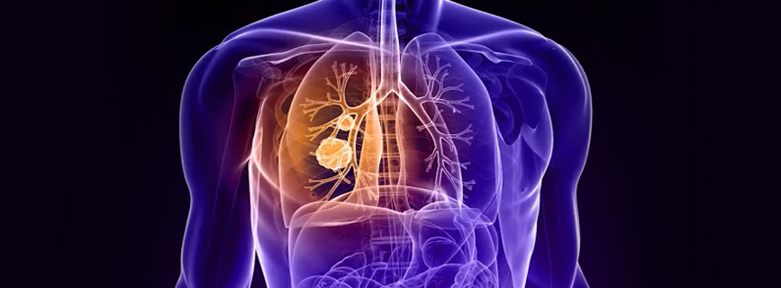 WATCH VIDEO - Lung Cancer: Symptoms, Causes and Treatment 